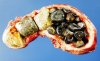 Gallstones.jpg